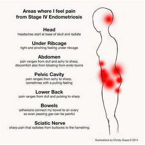 can endometriosis cause back and hip pain